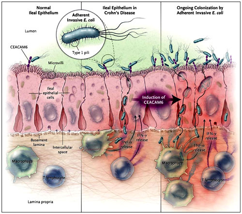 Figura 1: enfermedad de Crohn y la molécula de adhesión celular asociada al antígeno carcinoembrionario 6 (CEACAM6)