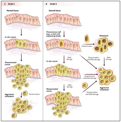 Figura 1: dos modelos de desarrollo y progresión del cáncer.