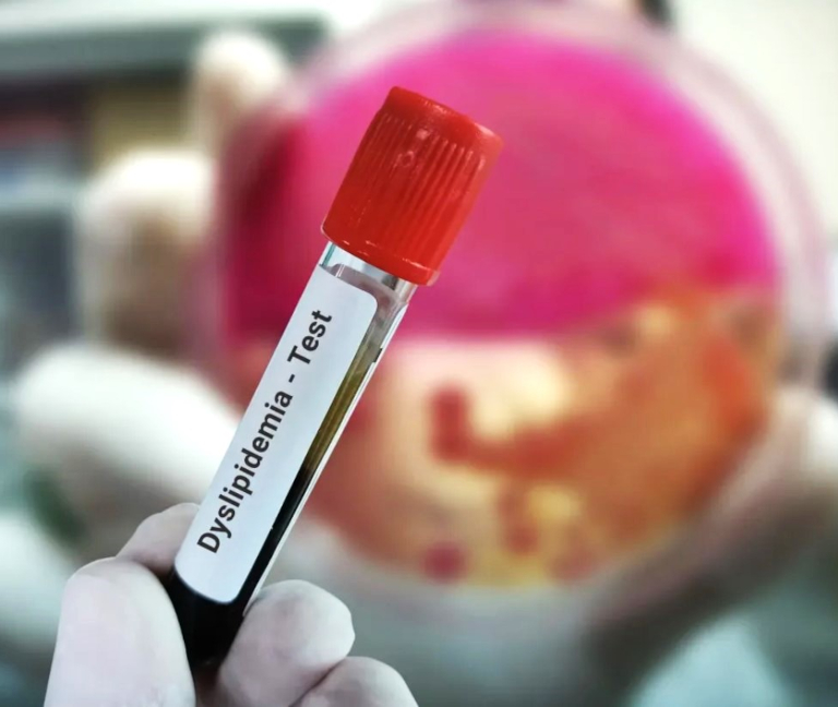 Guía de dislipidemia 2026: más allá del colesterol LDL