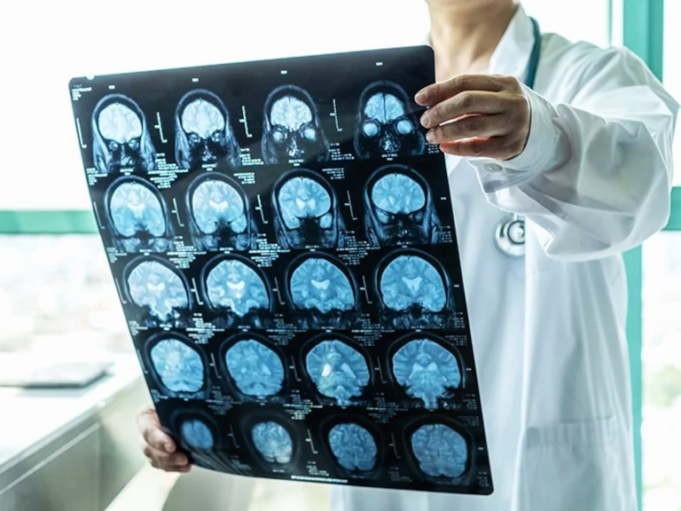 gravedad, ictus, reloj circadiano