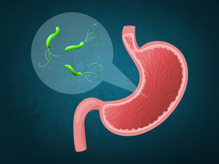 Helicobacter pylori, tratamiento para Helicobacter pylori, H. pylori, erradicación de H. pylori, terapia cuádruple con bismuto
