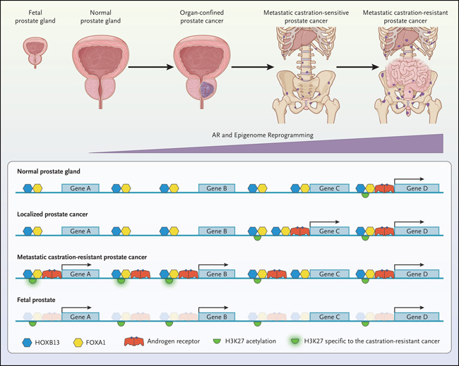 cáncer de próstata fisiopatología ceai calcifiere prostata