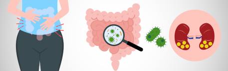Bacterias modificadas genéticamente para el tratamiento de cálculos renales