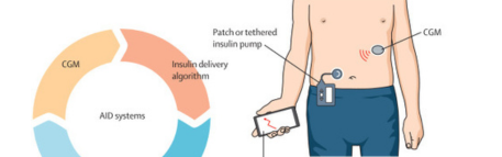 Hacia una cura para la diabetes tipo 1