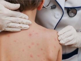 red mundial, sarampión, oms