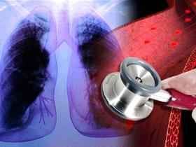 Riociguat demuestra beneficios en la hipertensión pulmonar