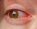 uveitis, agonistas del GLP-1, medicamentos GLP-1, enfermedad inflamatoria ocular