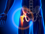 agonistas del receptor del péptido similar al glucagón-1, agonistas GLP-1, inhibidores de la dipeptidil peptidasa-4, DPP-4i, diabetes tipo 2, salud esquelética en diabetes tipo 2, seguridad ósea en diabetes tipo 2, pérdida ponderal, obesidad