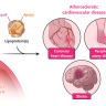 colesterol de lipoproteínas de baja densidad, LDL-C, colesterol LDL, hipercolesterolemia, prevención de la enfermedad cardiovascular aterosclerótica, aterosclerosis, edición de bases de ADN in vivo